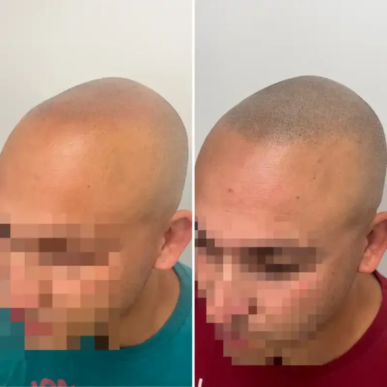 Fotos Antes Y Despues Micropigmentacion Capilar Donostia (1)