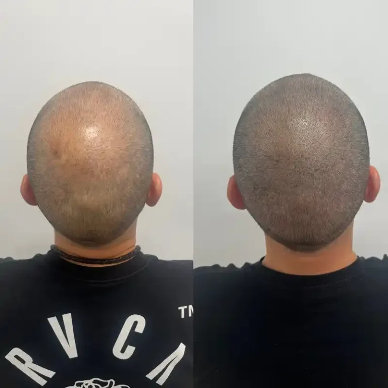 Fotos Antes Y Despues Micropigmentacion Capilar Donostia (2)