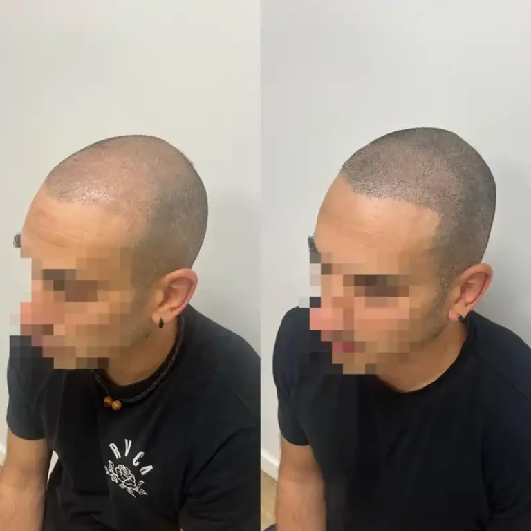 Fotos Antes Y Despues Micropigmentacion Capilar Donostia (3)