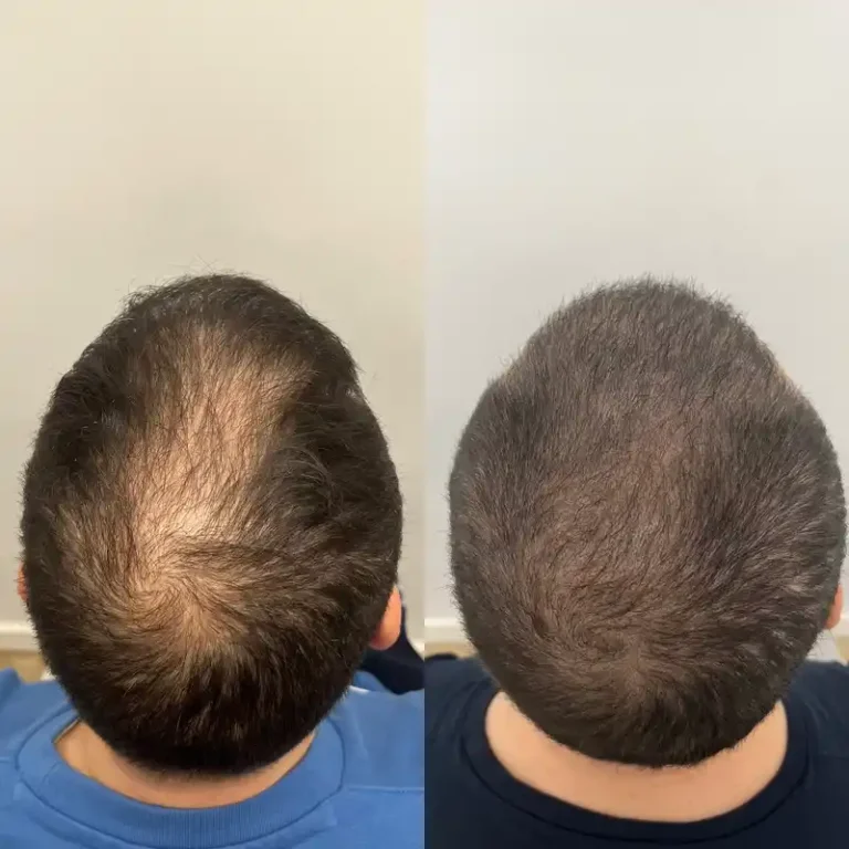 Fotos Antes Y Despues Micropigmentacion Capilar Donostia (8)
