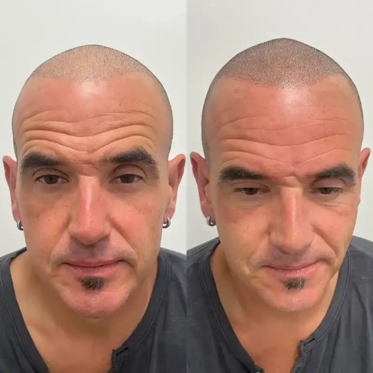 Fotos Antes Y Despues Micropigmentacion Capilar Donostia (9)