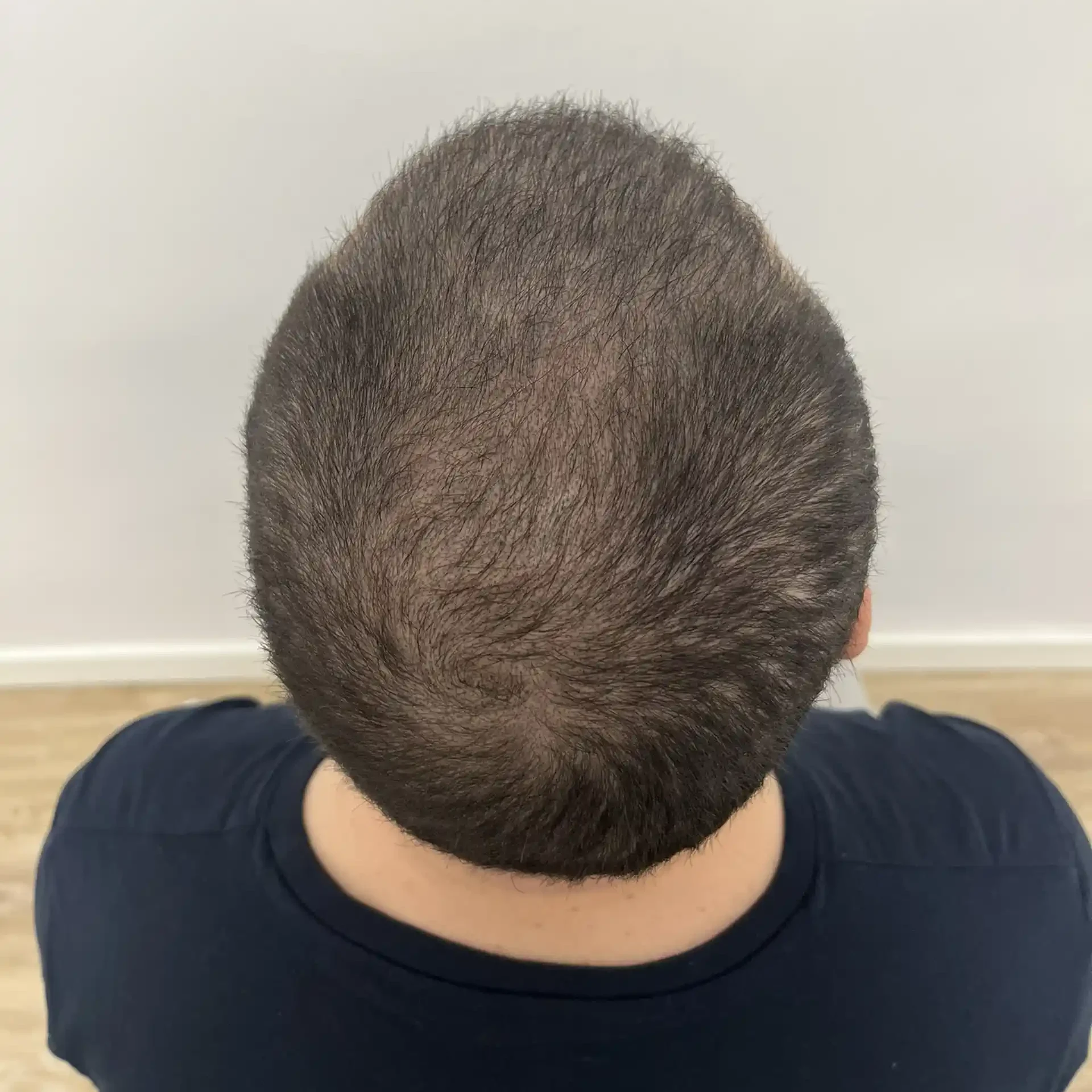 Micropigmentacion Capilar Donostia Cliente 4.2 (2)