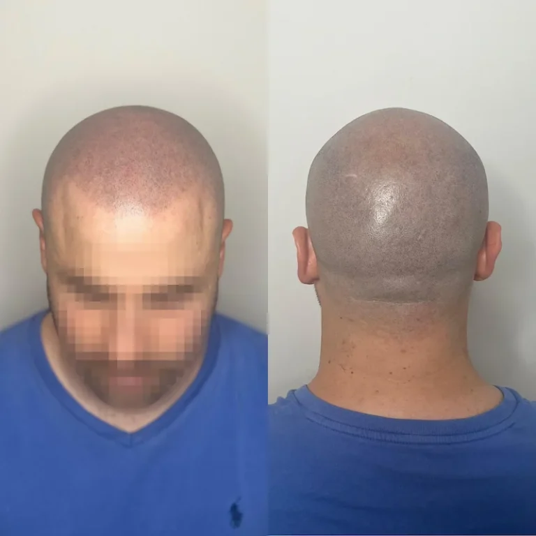 Micropigmentacion Capilar Antes Y Despues