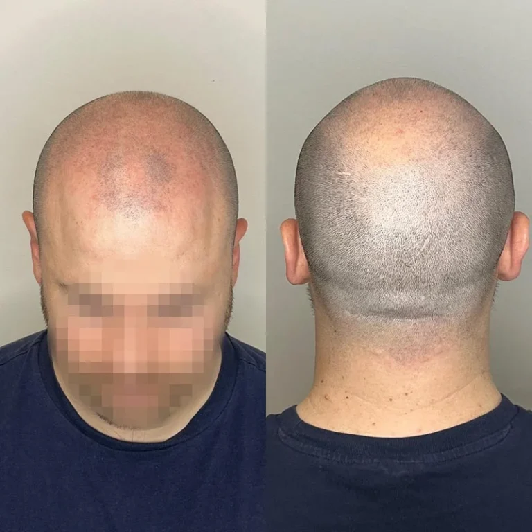Micropigmentacion Capilar Antes Y Despues1
